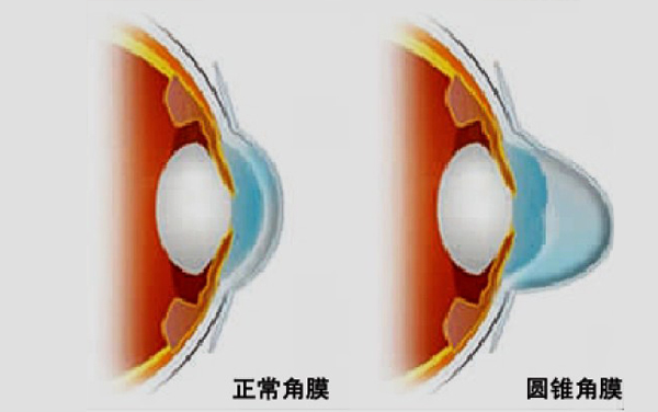 圓錐角膜怎么