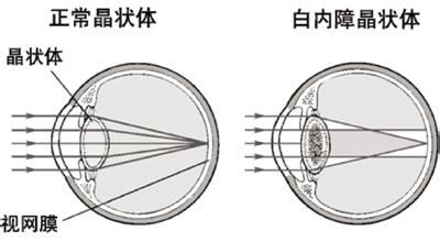 白內(nèi)障為何會影響視力