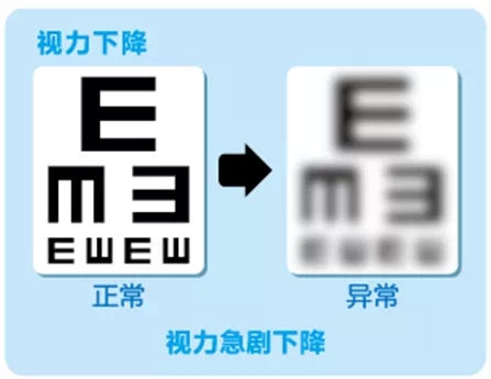 視網(wǎng)膜脫離啥癥狀？這張圖告訴你！