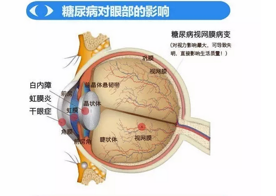 你造嗎？糖尿病晚期眼睛會致盲！