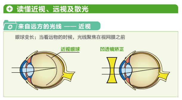 【看圖解】一張圖教你看懂近視、遠(yuǎn)視和散光