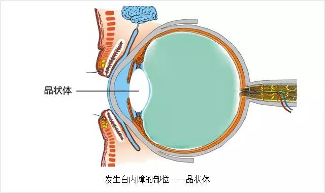 眼科主任告誡白內(nèi)障這幾大誤區(qū)，80%的老人上當(dāng)